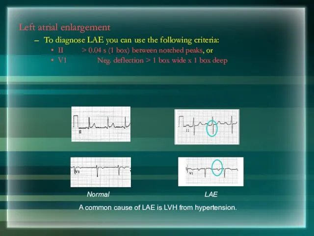 Left atrial enlargement To diagnose LAE you can use the