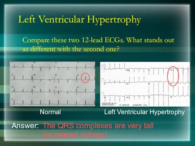 Left Ventricular Hypertrophy Compare these two 12-lead ECGs. What stands out as different