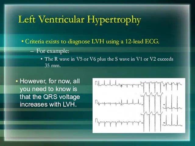 Left Ventricular Hypertrophy Criteria exists to diagnose LVH using a 12-lead ECG. For