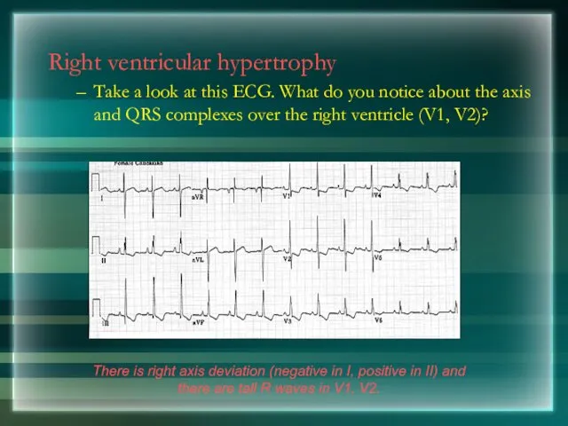 Right ventricular hypertrophy Take a look at this ECG. What do you notice