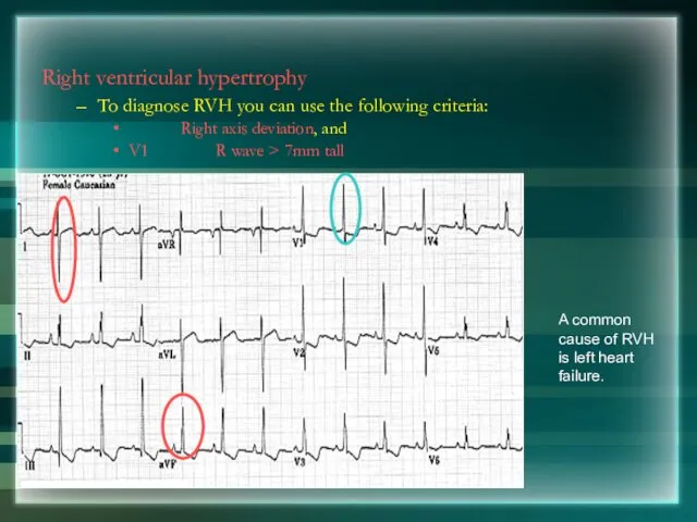 Right ventricular hypertrophy To diagnose RVH you can use the following criteria: Right
