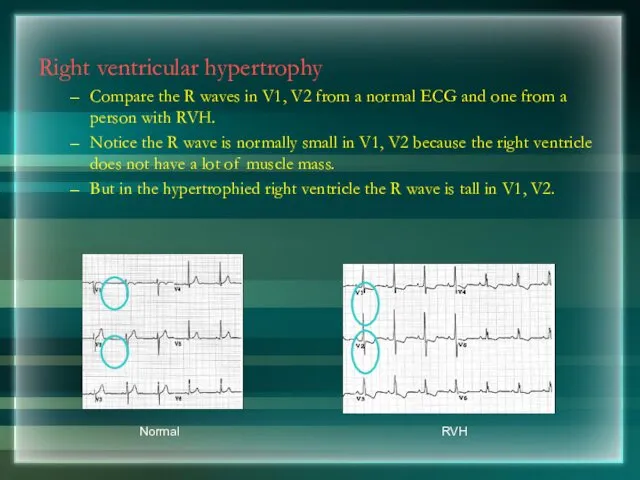 Right ventricular hypertrophy Compare the R waves in V1, V2 from a normal