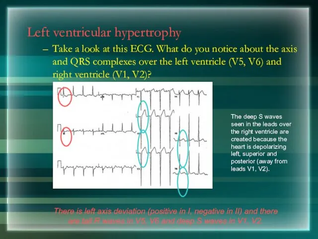 Left ventricular hypertrophy Take a look at this ECG. What do you notice