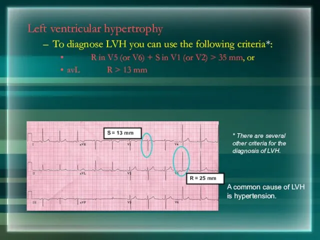 Left ventricular hypertrophy To diagnose LVH you can use the following criteria*: R