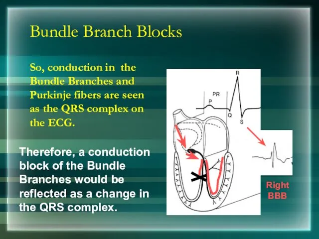 Bundle Branch Blocks So, conduction in the Bundle Branches and Purkinje fibers are