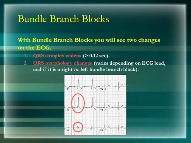 Bundle Branch Blocks With Bundle Branch Blocks you will see two changes on