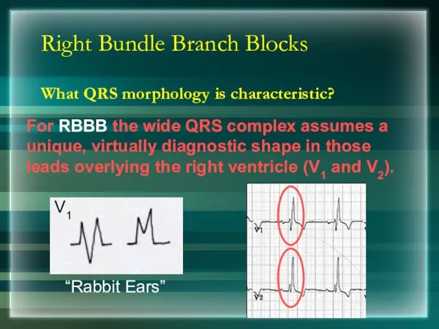 Right Bundle Branch Blocks What QRS morphology is characteristic?