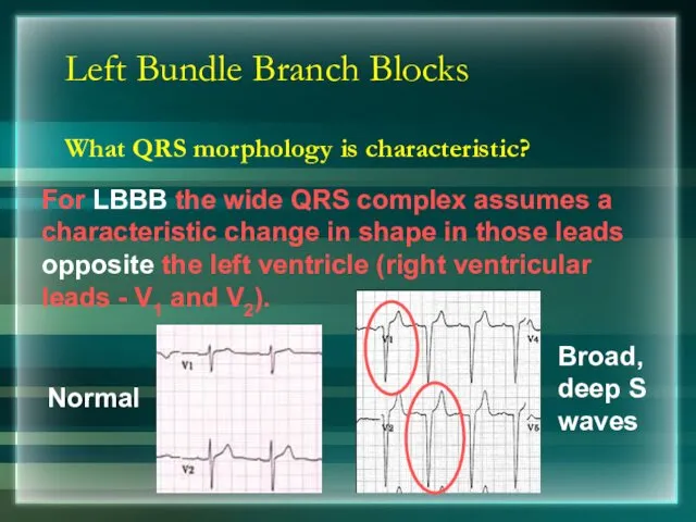 Left Bundle Branch Blocks What QRS morphology is characteristic? Normal