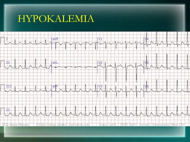 HYPOKALEMIA