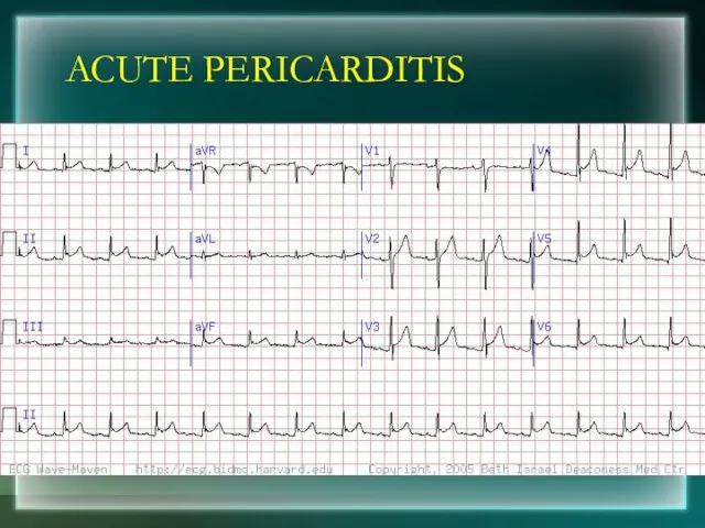 ACUTE PERICARDITIS