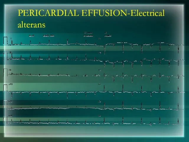 PERICARDIAL EFFUSION-Electrical alterans