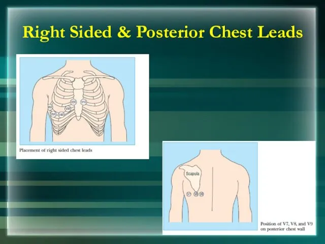 Right Sided & Posterior Chest Leads