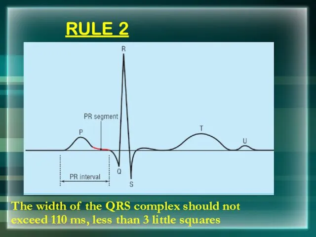 RULE 2 The width of the QRS complex should not exceed 110 ms,