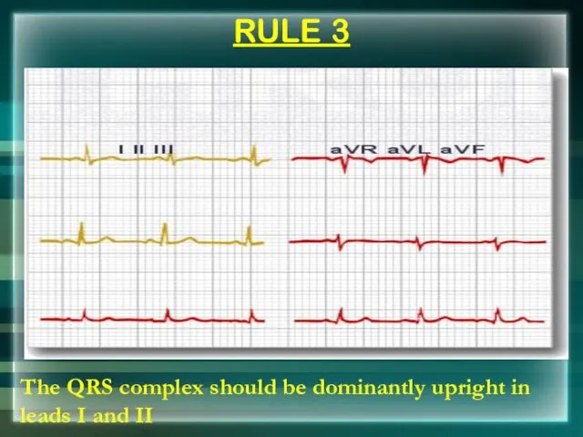 RULE 3 The QRS complex should be dominantly upright in leads I and II