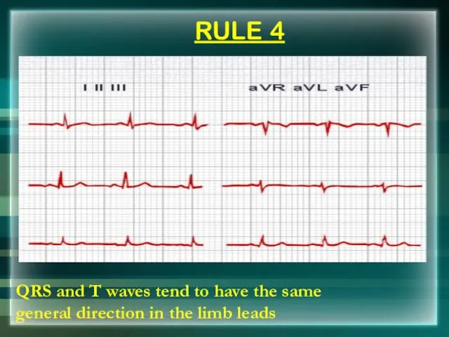 RULE 4 QRS and T waves tend to have the same general direction