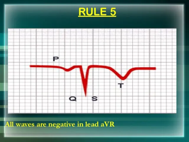 RULE 5 All waves are negative in lead aVR