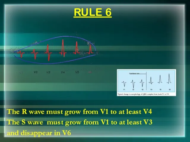 RULE 6 The R wave must grow from V1 to