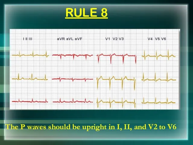 RULE 8 The P waves should be upright in I, II, and V2 to V6