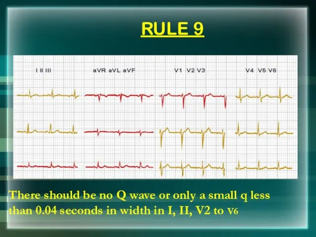 RULE 9 There should be no Q wave or only a small q
