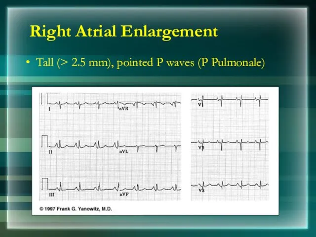 Right Atrial Enlargement Tall (> 2.5 mm), pointed P waves (P Pulmonale)