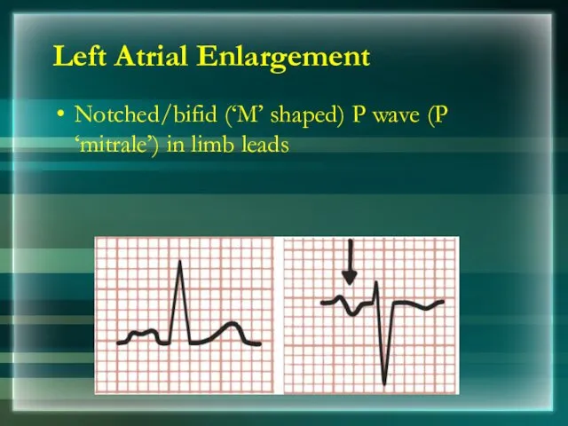 Notched/bifid (‘M’ shaped) P wave (P ‘mitrale’) in limb leads Left Atrial Enlargement