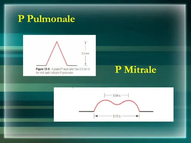 P Pulmonale P Mitrale