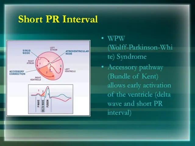 Short PR Interval WPW (Wolff-Parkinson-White) Syndrome Accessory pathway (Bundle of Kent) allows early