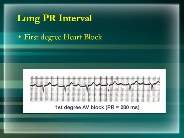 Long PR Interval First degree Heart Block