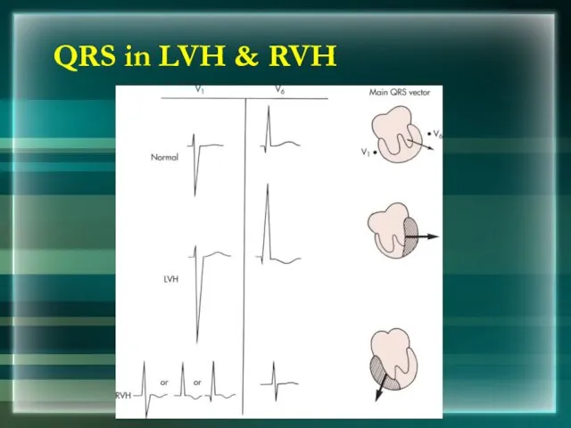 QRS in LVH & RVH