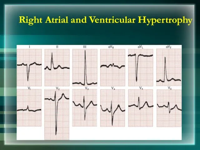 Right Atrial and Ventricular Hypertrophy