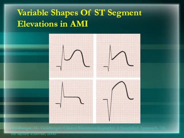 Variable Shapes Of ST Segment Elevations in AMI Goldberger AL.