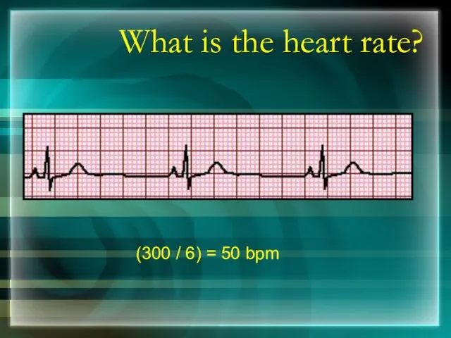 What is the heart rate? (300 / 6) = 50 bpm