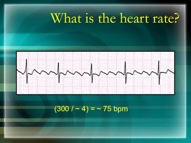 What is the heart rate? (300 / ~ 4) = ~ 75 bpm