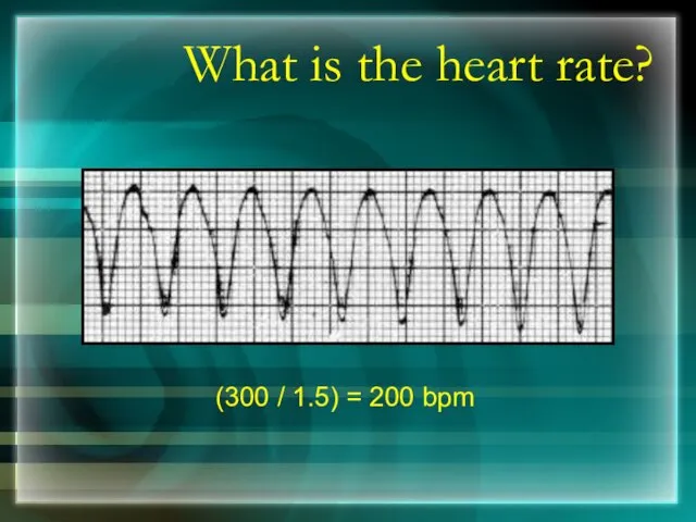 What is the heart rate? (300 / 1.5) = 200 bpm