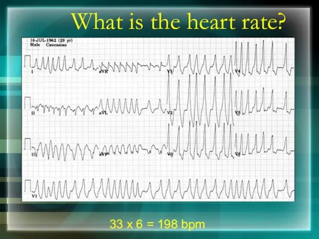 What is the heart rate? 33 x 6 = 198 bpm