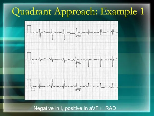 Quadrant Approach: Example 1 Negative in I, positive in aVF ? RAD