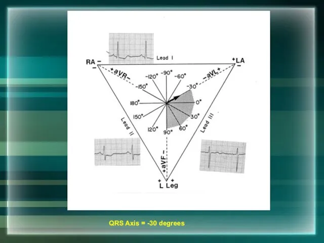 QRS Axis = -30 degrees