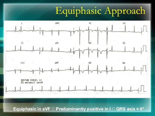 Equiphasic Approach Equiphasic in aVF ? Predominantly positive in I ? QRS axis ≈ 0°