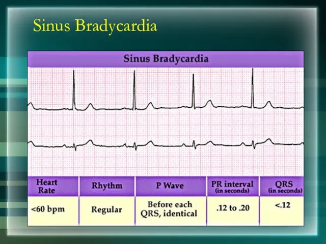 Sinus Bradycardia