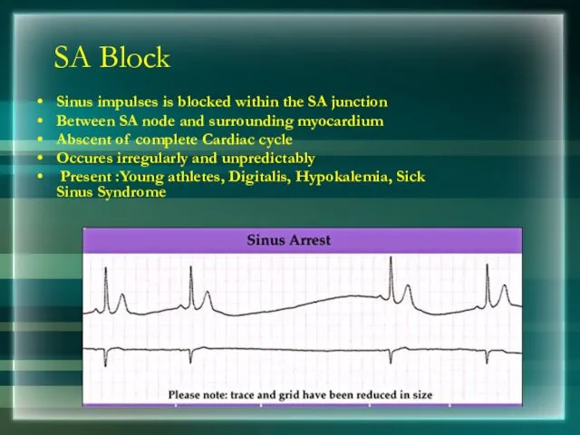 SA Block Sinus impulses is blocked within the SA junction Between SA node