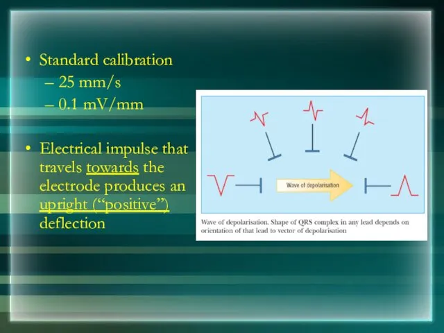 Standard calibration 25 mm/s 0.1 mV/mm Electrical impulse that travels towards the electrode