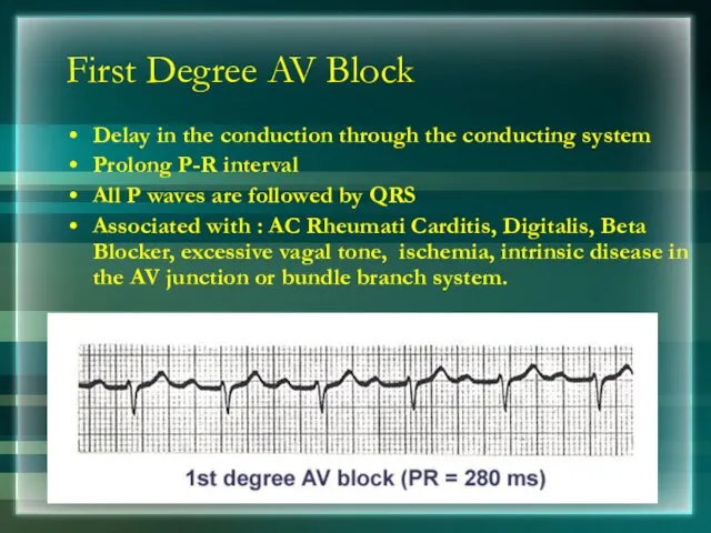 First Degree AV Block Delay in the conduction through the conducting system Prolong