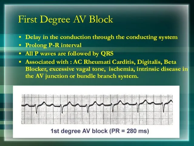 First Degree AV Block Delay in the conduction through the