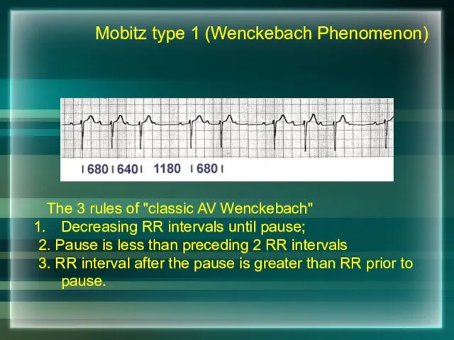 The 3 rules of "classic AV Wenckebach" Decreasing RR intervals until pause; 2.