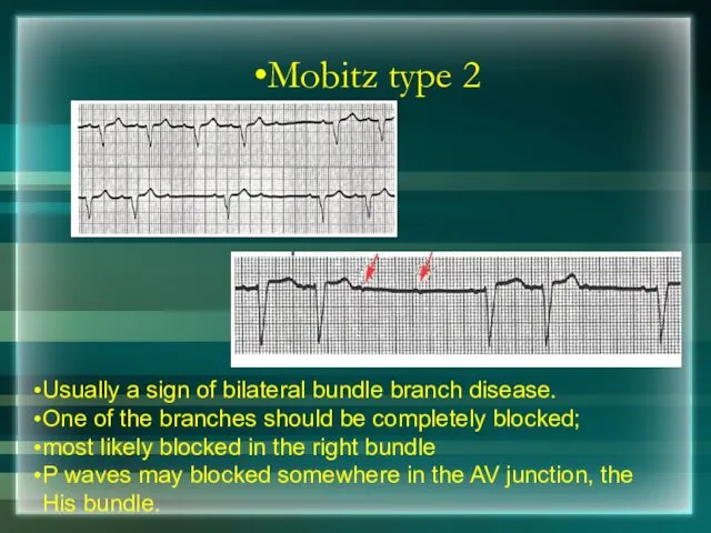 Mobitz type 2 Usually a sign of bilateral bundle branch disease. One of