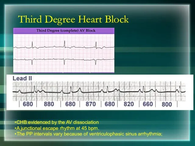 Third Degree Heart Block CHB evidenced by the AV dissociation A junctional escape