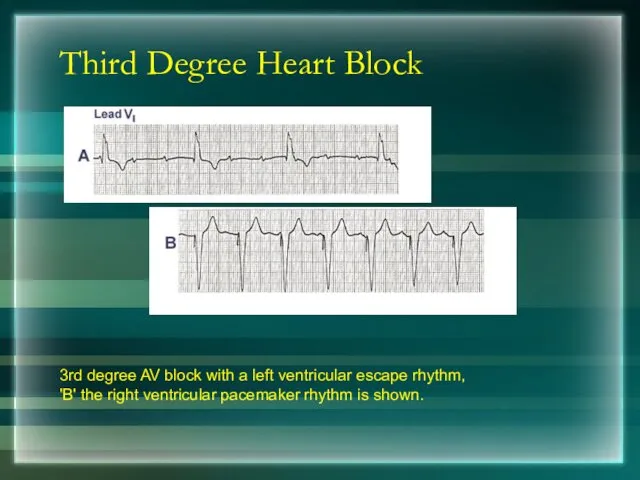 Third Degree Heart Block 3rd degree AV block with a