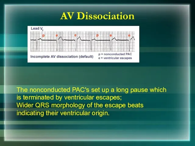 The nonconducted PAC's set up a long pause which is terminated by ventricular