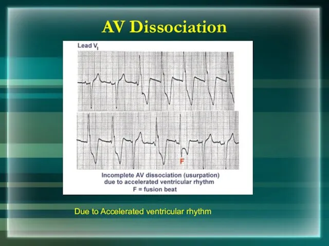 AV Dissociation Due to Accelerated ventricular rhythm