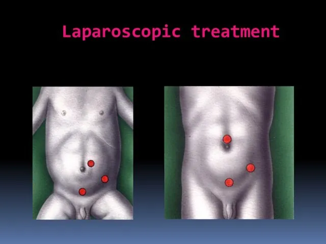 Laparoscopic treatment